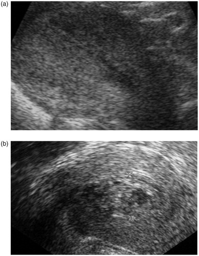 Figure 2. Vaginal ultrasound. (a) Uterine cavity immediately after aspiration of an 8-week pregnancy. (b) Presence of blood clots in the same woman 10 days after surgical abortion.