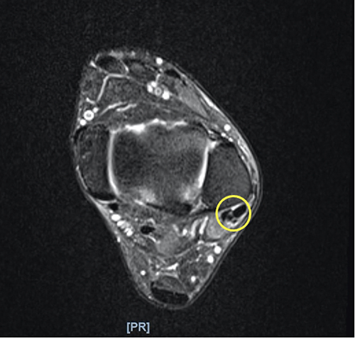 Figure 4 Preoperative ankle MRI showed initial diagnosis of peroneal brevis split tear. The yellow circle indicated a split tear of peroneal brevis tendon.