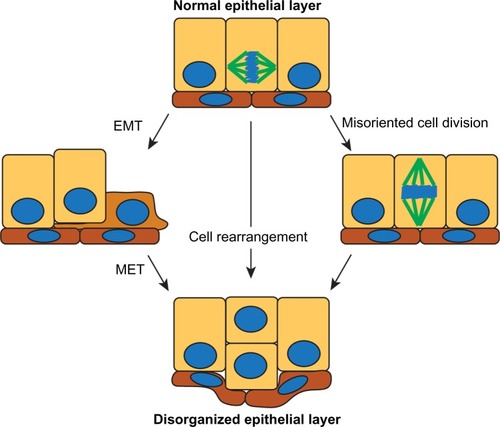 Figure 3 Potential mechanisms by which normal epithelial organization can be lost early in the progression of breast cancer.