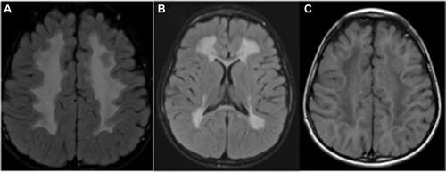 Figure 1 Magnetic resonance imaging of the brain in a 4year old child with Sjogren Larsson syndrome demonstrating hyperintense signal changes in the periventricular and deep white matter on FLAIR axial view (A and B) and hypointense signal changes on T1weighted axial image (C).