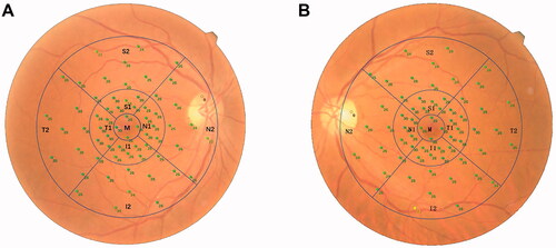 Figure 1. Diagram of the ETDRS chart. The retinal sensitivity test results of microperimetry are automatically matched with the fundus photos. (A) Right eye; (B) Left eye.