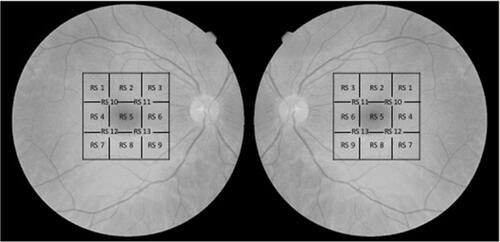 Figure 2 Customized 13-points-grid for microperimetry for right and left eyes. Diagram showing the location of each studied point in the microperimetric exam. The microperimetry covers the 4.5×4.5 mm of the central macula. Note that in each area of the macula the grid is named equally to the same grid in the other eye in order to analyze them as the same topographic area.Abbreviation: RS, retinal sensitivity.