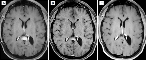 Figure 3 MRI Imaging Post-Treatment. (A and B) MRI after salvage therapy with near complete remission. (C) Repeat contrast enhanced MRI following day 100 work-up status post second ASCT shows complete remission.