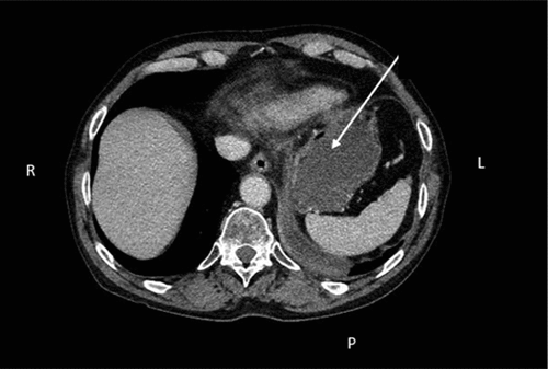 Figure 1. CT thorax/abdomen revealed cystic changes in tail/body of pancreas (arrow).