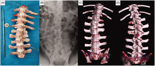 Figure 10. EOS in piglets induced by MWA at 3 months after the operation. Ablation power, 20 W; ablation time, 40 s; spine segments ablated, 3; needle ablation, single. (A) Gross spine image. (B) Anteroposterior X-ray image of the spine. (C,D) Three-dimensional computed tomography (CT) image of the spine.