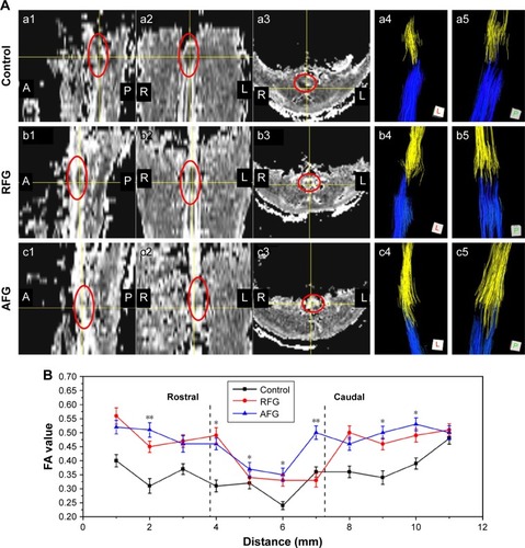 Figure 6 Representative FA maps, tractography images, and FA values of the spinal cord at 16 weeks after the implantation. (A) The bright region indicates high anisotropy in the representative FA maps (a1–a3, b1–b3 and c1–c3, where A, P, L, and R represent anterior, posterior, left, and right, respectively). In the images of (a4–a5), (b4–b5), and (c4–c5), yellow stands for fibers traced from the ROI rostral to the epicenter, where blue corresponds to fibers traced from the ROI caudal to the epicenter. (B) FA value versus location (mm) reveals statistically significant differences between the AFG group and the RFG group at the lesion site (n = 4), *p < 0.05, **p < 0.01. Furthermore, the FA value of AFG revealed statistically significant differences from control group animals at all locations along the spinal cord (p < 0.01).Abbreviations: AFG, aligned fibrin hydrogel; FA, fractional anisotropy; RFG, random fibrin hydrogel; ROI, region of interest.