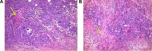 Figure 5 Histopathological examination of solid tumor.