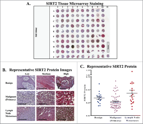 Figure 1. SIRT2 staining is increased in human metastatic melanoma samples. (A) Whole image of the SIRT2/AEC stained slide with hematoxylin counterstaining. ME1004d indicates the catalog number from US Biomax, Inc. that was used for the study. (B) Representative 20x images of individual cores with low, medium, and high SIRT2 expression are shown. Scale bar = 200 μm. (C) The mean whole cell SIRT2 protein levels of each core as determined by Vectra analysis are plotted. Error bars represent mean ± SEM.