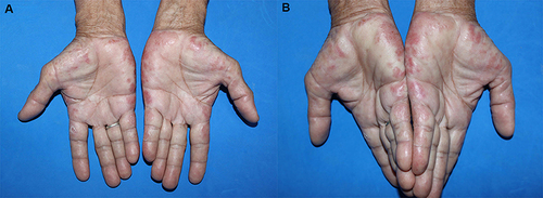 Figure 1 (A and B) A 75-year-old male with multiple erythematous papules and plaques on the margins of both hands.