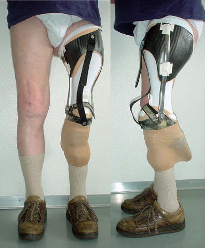 Figure 3.  Patient standing with the definitive prosthesis.