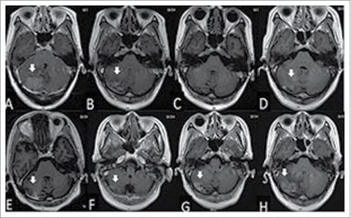 Figure 1. The woman was diagnosed with brain metastasis of breast cancer by gadolinium-enhanced T1-weighted MRI (A). After whole brain radiation therapy (40 Gy in 20 fractions), the volume of tumor was reduced significantly (B), and disappeared 8 months after radiotherapy (C). The tumor located in the cerebellum enlarged in the 10th and 11th months after radiotherapy (D and E, respectively). Gadolinium-enhanced T1-weighted MRI showing the reduced size of the tumor at 2 months (F), widespread scattered irregular enhancement at 4 months (G), and increased tumor size at 13 months (H) after gamma knife treatment.
