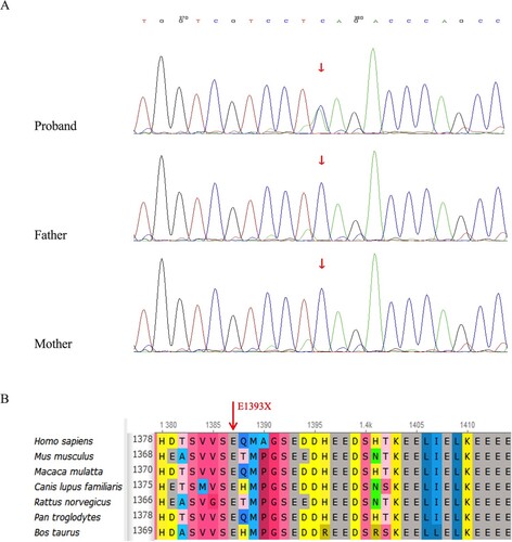 Figure 1. Results of gene sequencing and conservation analysis. (A) De novo variant of KAT6A (variant c.4177G>T). (B) conservation analysis of mutation site.