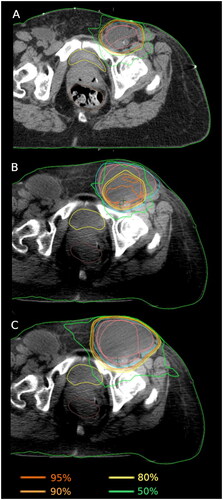 Figure 3. Example of vulvar carcinoma patient with anatomical change due to lymphocele and the direct consequence in dose coverage. A) Reference plan, B) Daily CBCT using scheduled plan, C) Daily CBCT using adapted plan. Isodose levels 95%, 90%, 80% and 50% are visualized. CTV and PTV contours are shown in pink and blue, respectively.