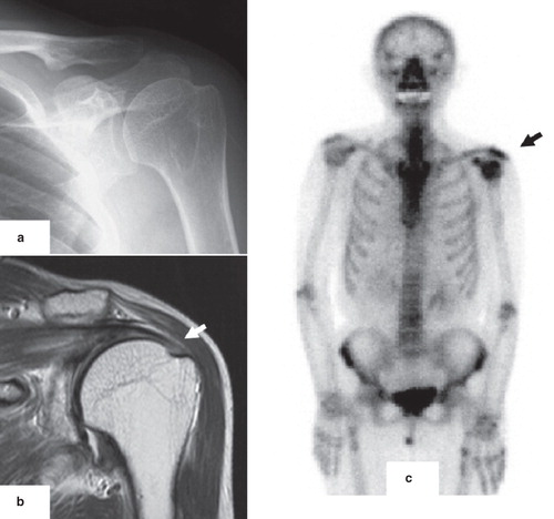 Figure 3. Case 1: A 71-year-old male with a rotator cuff tear in the left shoulder. No obvious changes of osteoarthritis are observed on plain X-rays (A). A full-thickness rotator cuff tear is observed on the coronal T2 WI MRI (B, arrow). An increase of RI uptake in the left shoulder joint is observed in the bone scintigram (C, arrow). However, there are no left–right differences in RI uptake for elbow or wrist joints.
