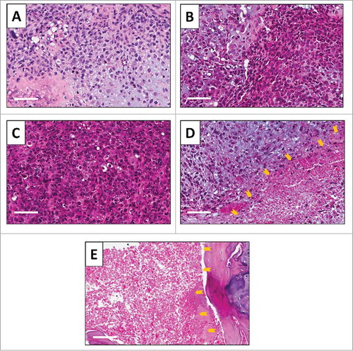 Figure 5. Tumor histology. Hematoxylin and eosin (H&E)-stained section of the (A) original patient tumor; (B) untreated PDOX tumor; (C) PDOX tumor treated with CDDP; (D) PDOX tumor treated with S. typhimurium A1-R i.v.; and (E) PDOX tumor treated with S. typhimurium A1-R i.a.. Necrotic areas are indicated by yellow arrows. White scale bars: 80 µm.