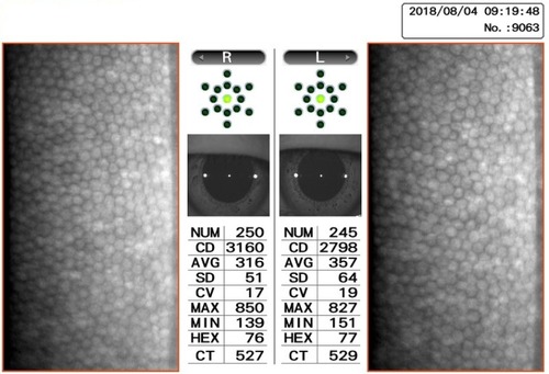 Figure 4 Specular microscopy showing CECDs of both eyes at 12 months after the initial visit.