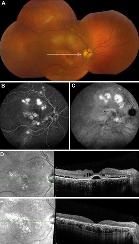 Figure 2 Clinical features on multimodal imaging of the right eye of a 44-year-old male patient with severe chronic central serous chorioretinopathy and a bullous inferior retinal detachment.