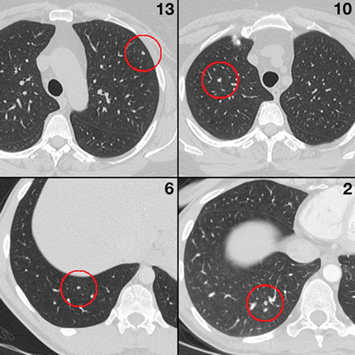 Figure 1. CT images of tissue changes (pulmonary nodules), encircled (Rubin et al. Citation2015).