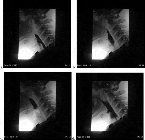 Figure 5. (ad). Video-fluoroscopy swallow study