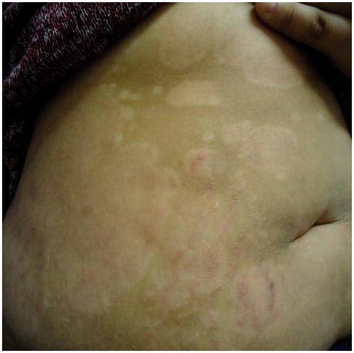 Figure 4. After treatment with ustekinumab (week 16).