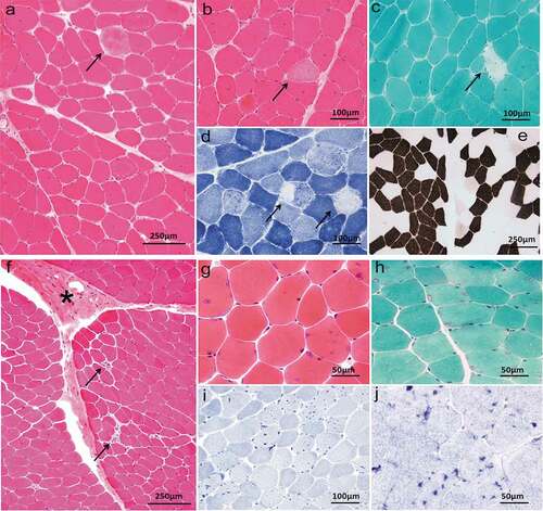 Figure 3. Muscle biopsy of patient 1,5. Patient 1, HE (a, b), MGT (c) and NADH-TR (d) demonstrated variation of fiber diameter, and scattered degenerative or necrotic muscle fibers (arrowhead). ATPase pH = 4.3 (e) demonstrated predominance of type 1 and type 2 fibers. Patient 5, HE (f, g), MGT (h), NADH-TR (i) and SDH (j) showed occasional degenerative or necrotic muscle fibers (arrowhead), connective tissue proliferation (asterisk) and lots of tubular aggregates (hyperchromatism)