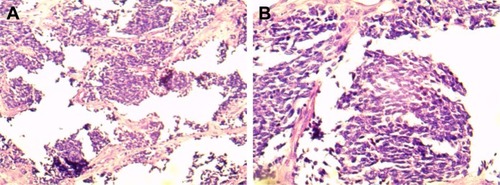 Figure 4 Pathological findings of hematoxylin and eosin-stained tumor sections.