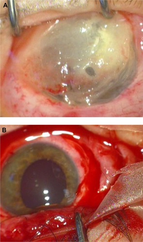 Figure 1 Ocular surface before and after necrotic tissue excision.