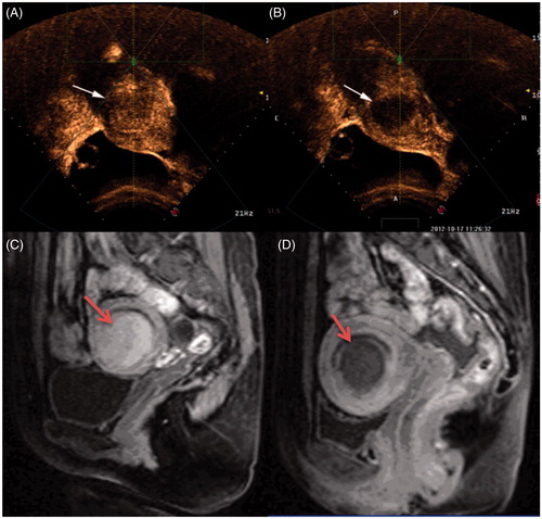 Figure 1. Contrast-enhanced ultrasound images and MR images obtained from a patient with type I submucosal fibroid. (A) Pre-procedure contrast-enhanced ultrasound image shows a submucosal fibroid (arrow). (B) Contrast-enhanced ultrasound image obtained immediately after HIFU shows the non-perfused area (arrow). (C) Pre-procedure MRI shows a 4.5 × 4.3 × 4.0 cm submucosal fibroid located at the anterior wall of the uterus (arrow). (D) Contrast-enhanced MRI obtained 1 day after HIFU shows the fractional ablation was 90% (arrow).