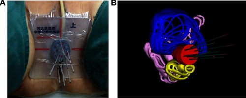 Figure 2 3D printed minimally invasive guidance template implantation (A) and 3D model after reconstruction of tumor target volume and organs at risk (B). Red refers to the tumor target volume, blue refers to the bladder, yellow refers to the rectum, and pink indicates the sigmoid colon.
