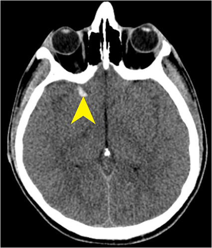 Figure 8 Axial NECT CT of 16-year-old male who fell from 2 m height. Brain window reveals right frontal haemorrhagic cortical contusion (yellow pointed arrow).
