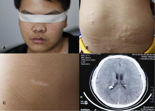 Figure 2 Clinical manifestations of proband. (A) Facial angiofibroma. (B) Shagreen patch. (C) Hypopigmented macules. (D) Subependymal nodules.