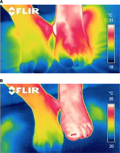 Figure 2 Infrared thermography before and after treatment with the SCCD