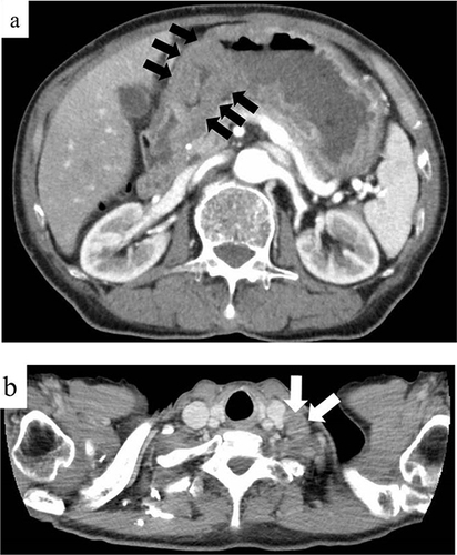 Figure 3 Radiological findings before treatment. (a and b) On contrast-enhanced computed tomography before treatment, a thickening of the wall of the middle to lower stomach (black arrows) and a swollen left supraclavicular lymph node (white arrows) were detected.