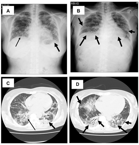 Figure 1 Chest X-ray (A and B) and computed tomography (C and D) of the case 1 patient on admission to our hospital on day 40 (A and C) and day 52 (B and D). Interstitial shadows in X ray and Ground-glass opacities (GGOs) in CT are found in both lung fields on admission to our hospital on day 40 (A and C). These interstitial shadows and GGOs were increased 12 days later on day 52 (B and D). Both of the lung volumes were also reduced on day 52 (B), compared with on day 40 (A). Arrows indicated the abnormal shadows in chest X-ray and CT, such as interstitial shadows and GGO.