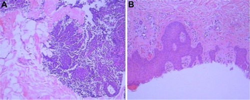 Figure 2 Case 1: skin biopsy before treatment – neutrophils, lymphocytes, or plasmacytes in a few small vessel walls (A) and no thrombus in vessel lumen and no fibrinoid necrosis in vessel wall (B).