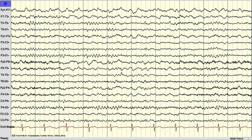Figure S1 EEG data of the patient.