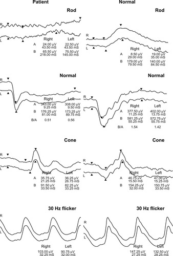 Figure 2 Recording of ERG from the patient.