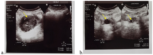 Figure 4. (a) Ultrasound examination. The yellow arrow indicates a 6 × 4 cm lesion. (b) Ultrasound examination. Arrows indicate two lymph nodal formations of 16 mm (left) and 9 mm (right).