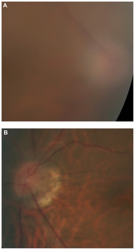 Figure 2 Fundus photos at presentation. (A) optic disc swelling in the right eye and (B) a tilted optic disc with peripapillary atrophy in the left eye.