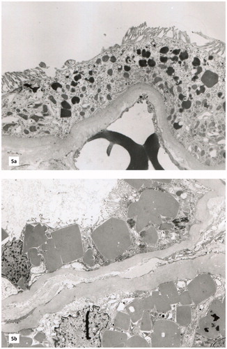Figure 5. (a) and (b) Electron microscopy (EM) showing electron-dense, intracytoplasmic round and rectangular crystalloid deposits of variable size in the proximal tubular cells.