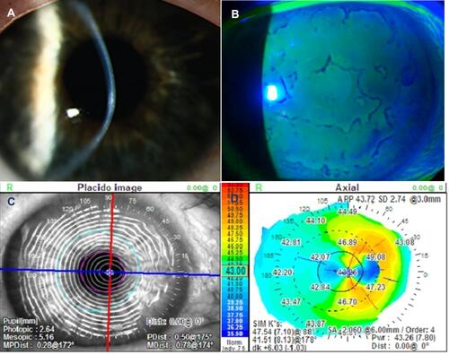 Figure 2 Images demonstrating clinically significant epithelial basement membrane dystrophy (EBMD). Slit lamp photography showing central focal anterior corneal opacities (A) Negative fluorescein staining can identify subtle EBMD and may extend beyond the visually involved area (B). Diagnosis can be confirmed with distorted Placido rings (C) and irregular mires on corneal topography (D).