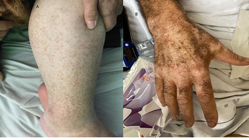 Figure 3 New skin manifestations (A) pigmented purpuric dermatosis (B) vitiligo-like rash.