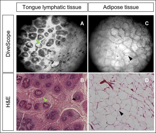 Figure 4 DiveScope images and hematoxylin-eosin (HE) staining pathology images of healthy tissue in the head and neck. Figure (A) and figure (B) are a DiveScope image and an HE-stained pathology image of tongue lymphatic tissues. Figure (C) and figure (D) are a DiveScope image and an HE-stained pathology image of adipose tissues. (A and B) show the lymphoid follicles (green arrows show) in the tongue lymphatic tissues. Figure (C) and figure (D) show transparent vacuoles in adipocytes and cell nuclei located at one side of the cytoplasm (black arrows show).