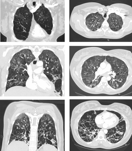 Figure 1 Chest computed tomography scan. Coronal (left) and horizontal (right) images show severe bronchiectasis with large cysts and mucus plugging.
