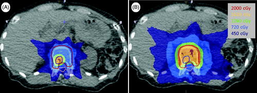 Figure 1. Delineation and planning for representative Case 7. (A) Axial planning’s CT slice showing the simultaneous integrated boost (SIB) SBRT dose distribution for a small metastasis in the L1 lumbar vertebral body. In this patient, the dose to the elective surrounding relatively healthy bone was effectively reduced from 18 to 11 Gy. (B) The non-SIB SBRT radiation treatment plan that this patient would have been given without the SIB SBRT approach.