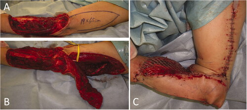 Figure 2. Intraoperative photographs of the patient in Case 1. (A) After extensive resection of the tumor, a large soft tissue defect, which exposed the radius, was observed. (B) While preserving the radial nerve, a 19 × 6.5 cm reverse lateral upper arm flap was raised. (C) The radius was covered with a flap, and a mesh skin graft was performed on a portion of the skin where the forearm muscle was exposed.