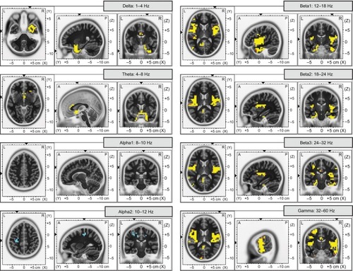 Figure 1 Cortical source activities evoked by cold pressor pain for the eight frequency bands.