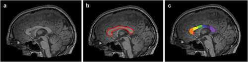 Figure 2. An example of corpus callosum area segmentation. The figure shows example data for an individual facing ASD in the ABIDE study. Figure A represents 3D volumetric T1-weighted MRI scan. Figure B represents segmentation of corpus callosum in red. Figure C represents the further division of corpus callosum according to the Witelson scheme (Witelson Citation1989). The regions W1(rostrum), W2(genu), W3(anterior body), W4(mid-body), W5(posterior body), W6(isthmus), and W7(splenium) are shown in red, orange, yellow, green, blue, purple, and light purple (Kucharsky Hiess et al. Citation2015).
