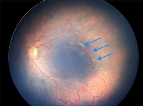 Figure 3 Left eye of a male infant born at 32 weeks weighing 1,300 g in a rural center showing occluded and closed loops of vessels abruptly stopping in posterior zone 1.