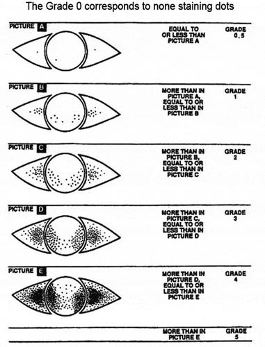 Figure 2. Grading of corneal conjunctival staining with the modified Oxford scale